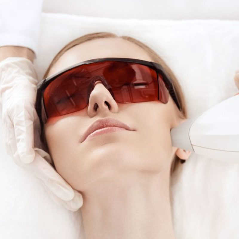 Facial laser hair removal