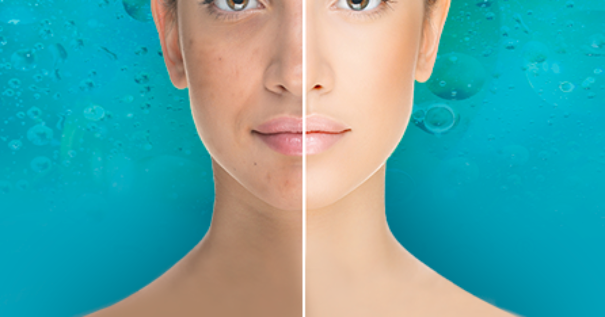 Micro-needle mesotherapy + BioRePeel Cl3