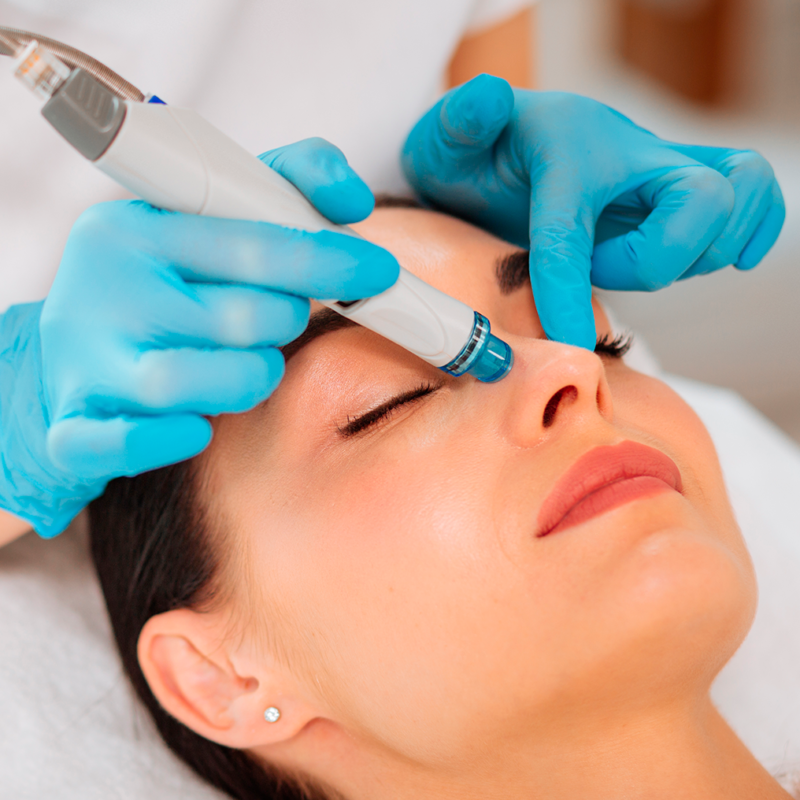 Micro-needle misotherapy + Yonelle Medesthetic