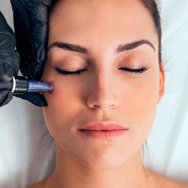 Micro-needle mesotherapy