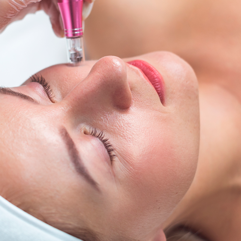 Micro-needle misotherapy + Platelet-rich plasma